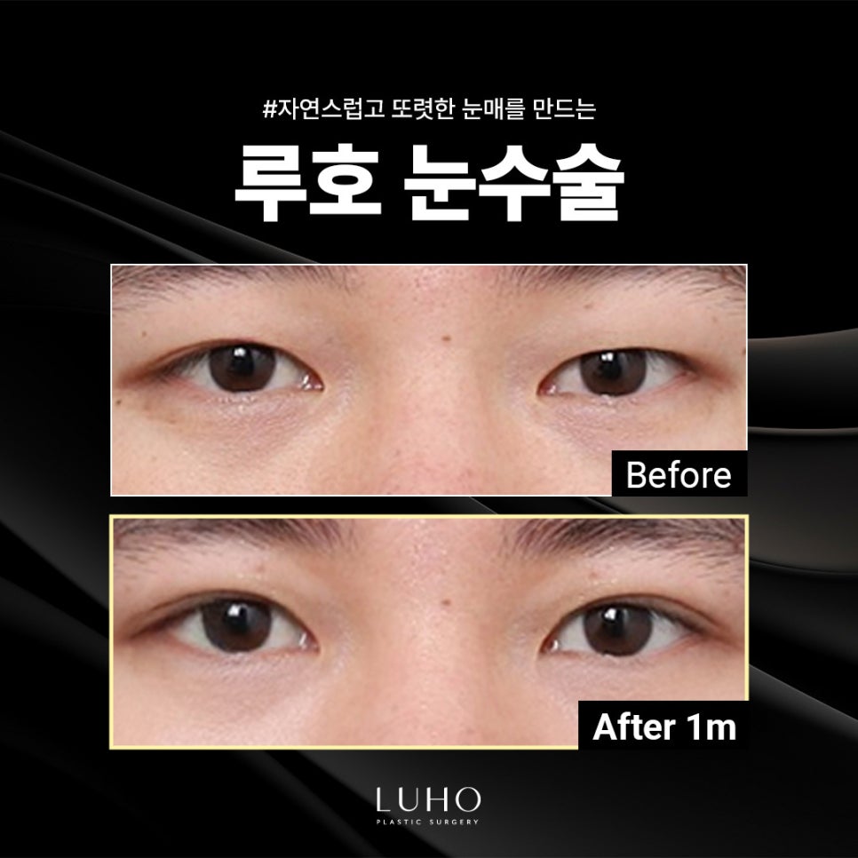 A Place Near Sinsa Station Known for Eye Surgery, Key Points for Improving the Eye Shape image 1