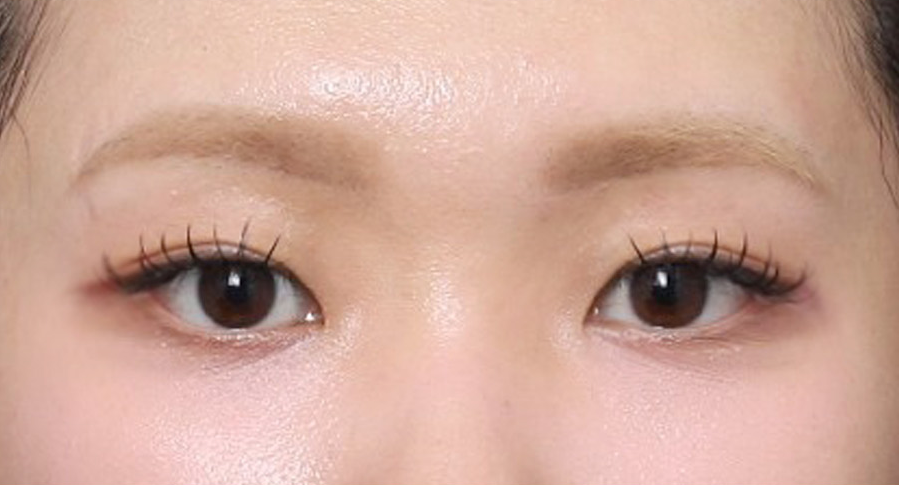 A More Open, Face-Appropriate Eye Shape After Outer-Corner Thread Lifting image 5