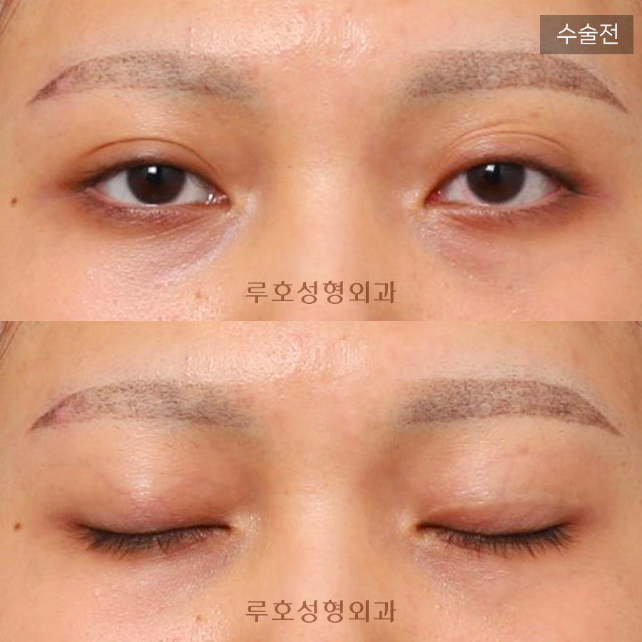신사역 루호성형외과 소시지 눈 재수술 관련 이미지 1