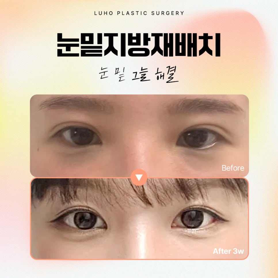 A Review of Shinsegae Station Under-Eye Fat Repositioning to Improve Dark Shadows Under the Eyes image 1