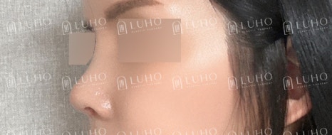 휜코를 교정하여 균형을 되찾은 코재수술 사례 관련 이미지 6