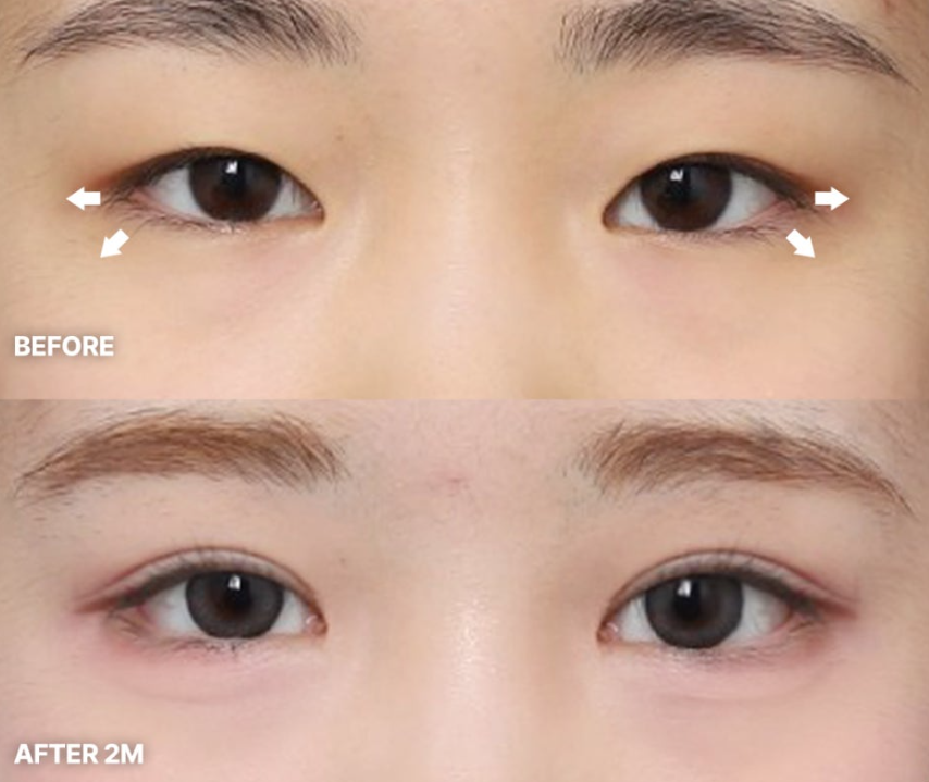What Are the Key Points Before and After Eyelid Correction at Apgujeong Station? image 6