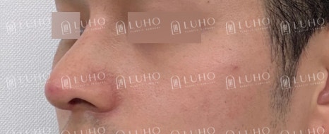코 필러 후에도 고민이 남은 코라인 개선한 남자 코재수술 관련 이미지 13