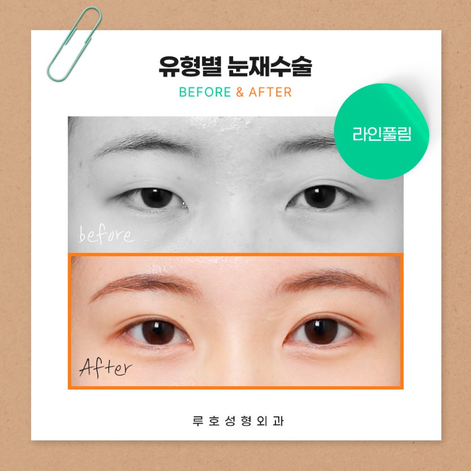 ［루호성형외과］유형별 눈재수술 관련 이미지 1