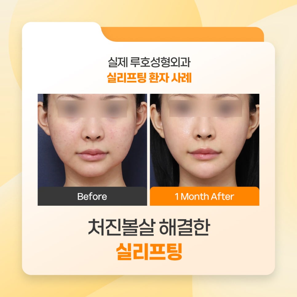 신사역 처진볼살 해결, 실리프팅 후기 관련 이미지 1
