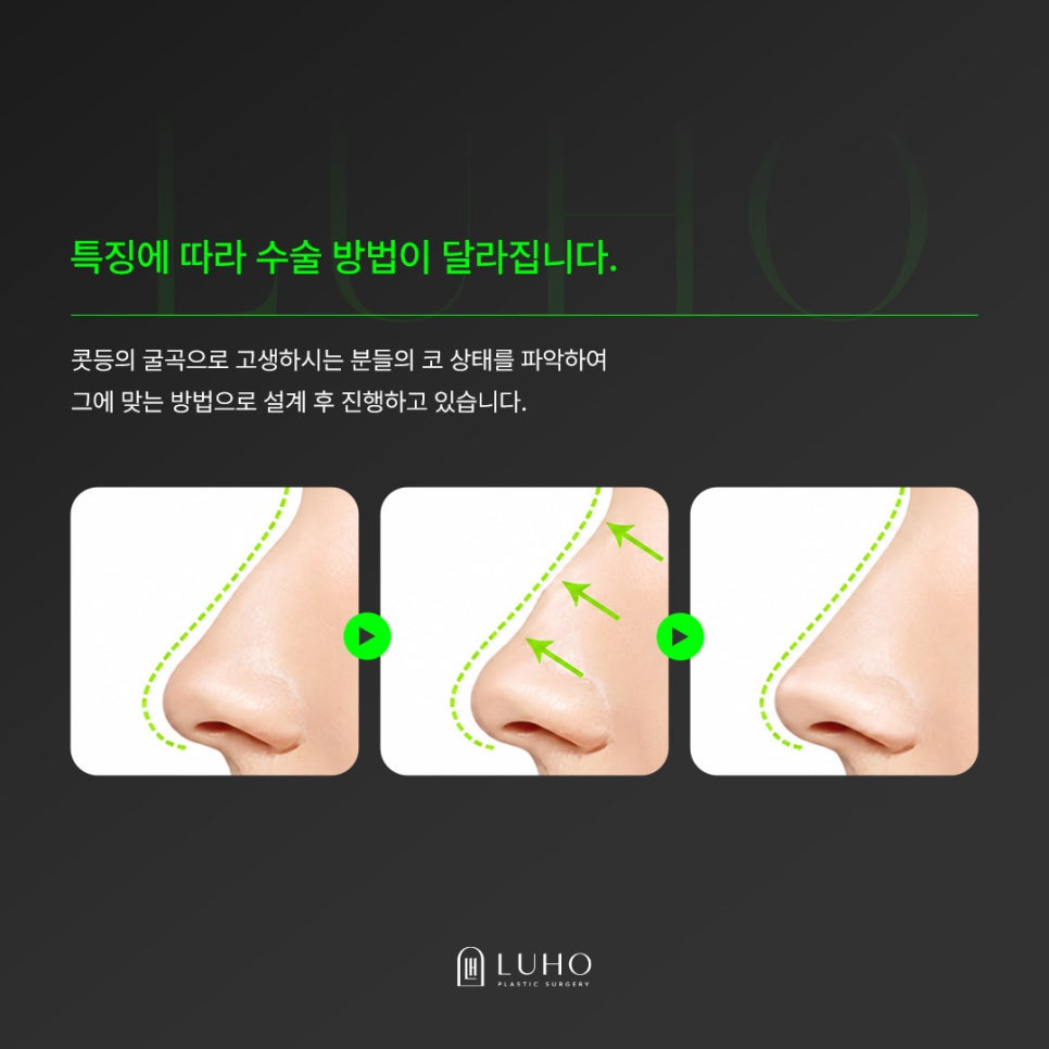 From the Curve of the Nasal Bridge to the Tip: Refining the Line with Hump Nose Surgery image 4