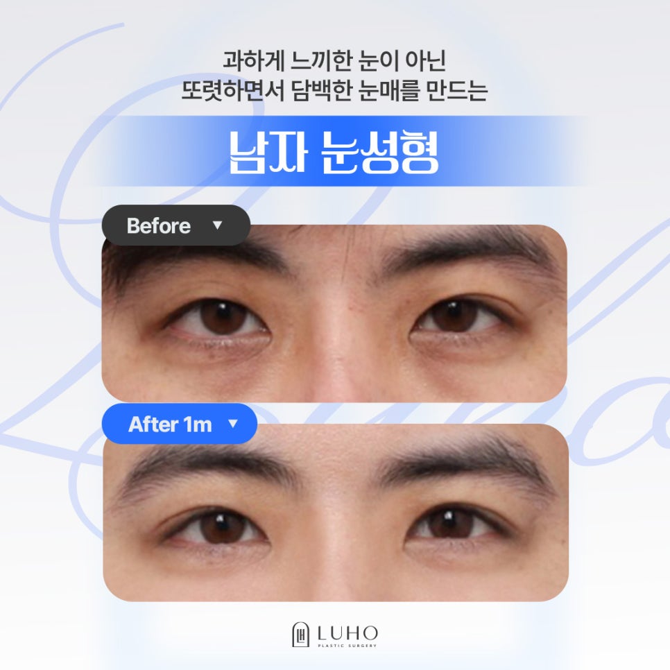 전체적인 인상을 바꾼 남자 눈성형 후기 관련 이미지 1
