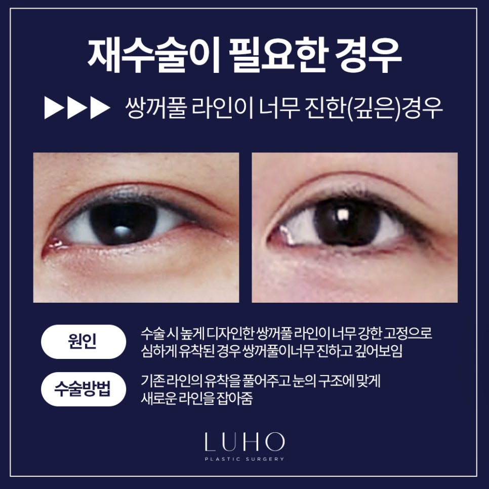 Double Eyelid Revision Surgery — Let’s Finish It at Luho! image 7