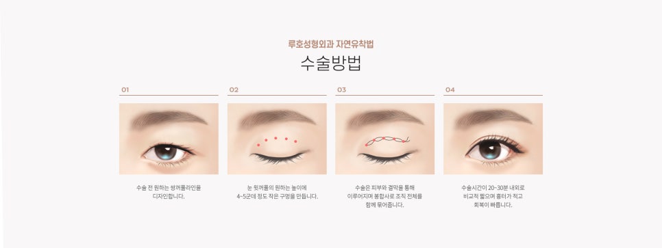 눈 수술법의 종류와 회복기간 #1 관련 이미지 3