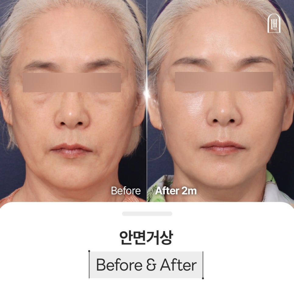 안면거상 전 알아야 할 3가지, 효과부터 흉터까지 관련 이미지 1