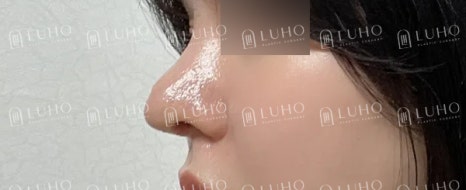 Redesigning a Bulbous Nose After 9 Years: Revision Rhinoplasty image 6