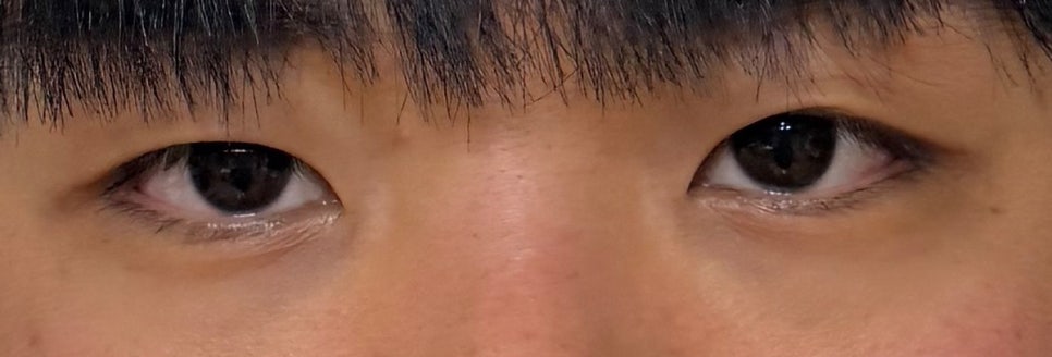 Review of Male Eye Surgery at Sinnonhyeon Station: Finding the Eye Shape That Suits Me image 3