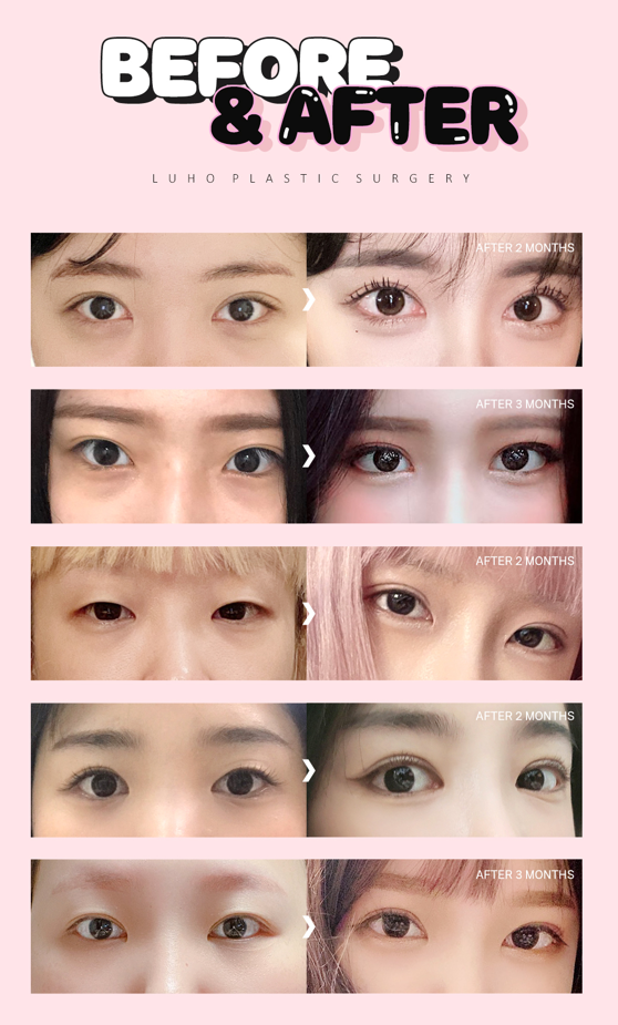 루호성형외과 수험생이벤트 관련 이미지 5