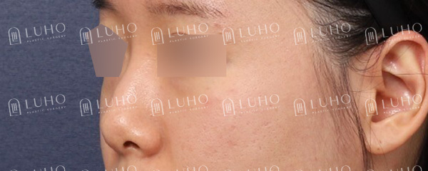Before and After Gangnam Rhinoplasty for a Hump Nose: Refining the Prominent Hump for a New Look image 2