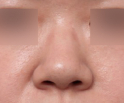 Before and After Nose Surgery Near Sinsa Station with a Refined Line Through Broad Nasal Bridge Correction image 3