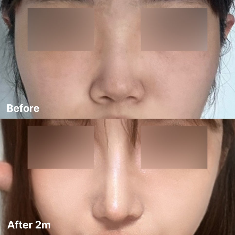 화려하고 또렷한 코 라인으로 개선한 수술 후기 관련 이미지 1