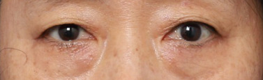 A Look at How Middle-Aged Eye Surgery at Sinsa Station Changes the Eye Shape image 3
