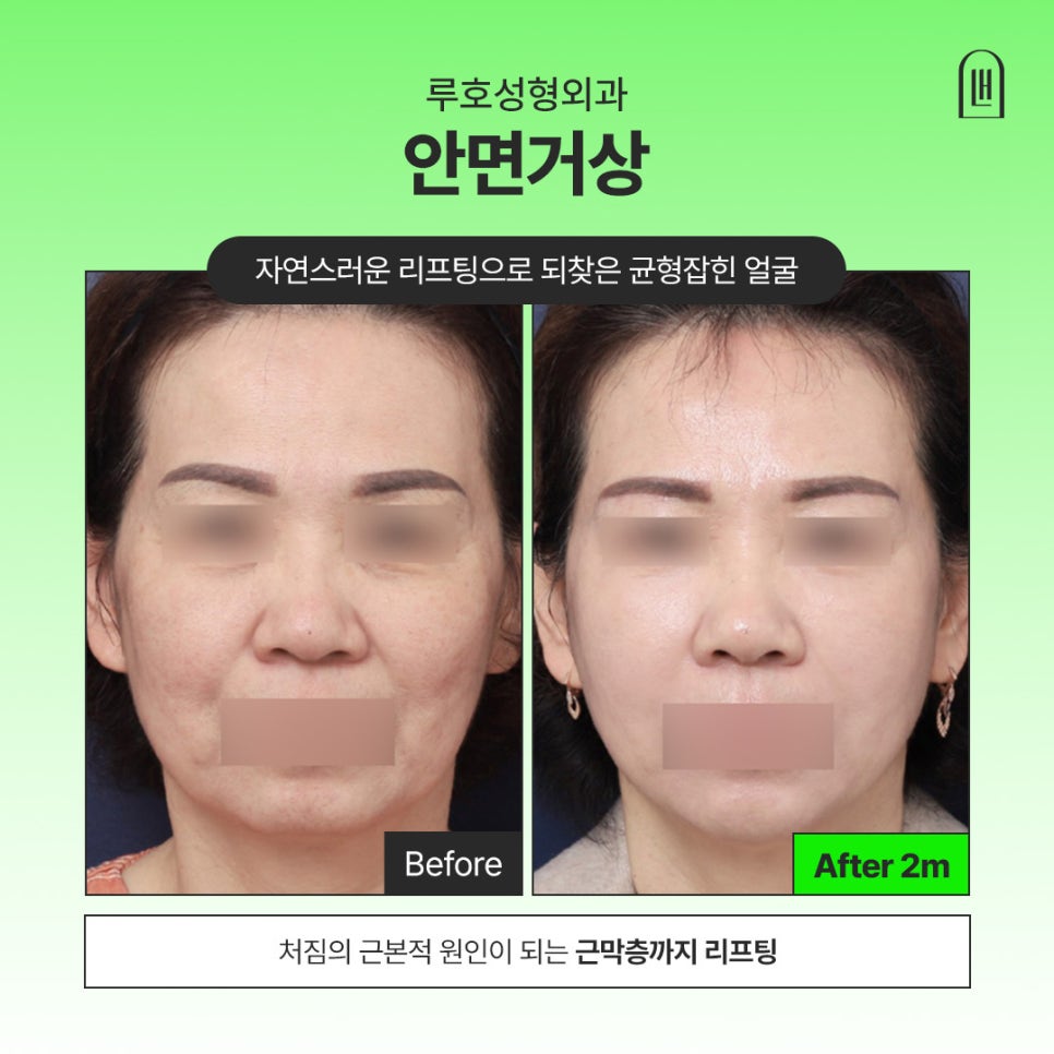 How a Facelift Restored Facial Balance That Had Changed Over Time image 1