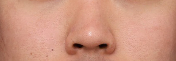 A Shinsegae Station Nose Surgery Review That Sharpened the Center of the Face with Tip Reduction image 3