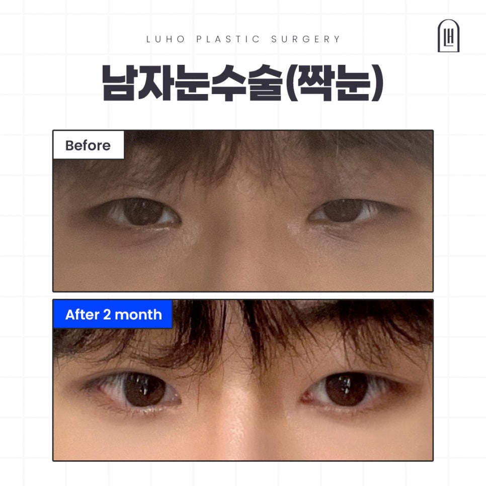 Review of Double Eyelid Surgery for Uneven Eyes at Sinsa Station for Men image 1