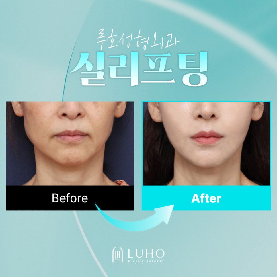늘어진 하안면을 개선한 신사역 실리프팅 전후 관련 이미지 1