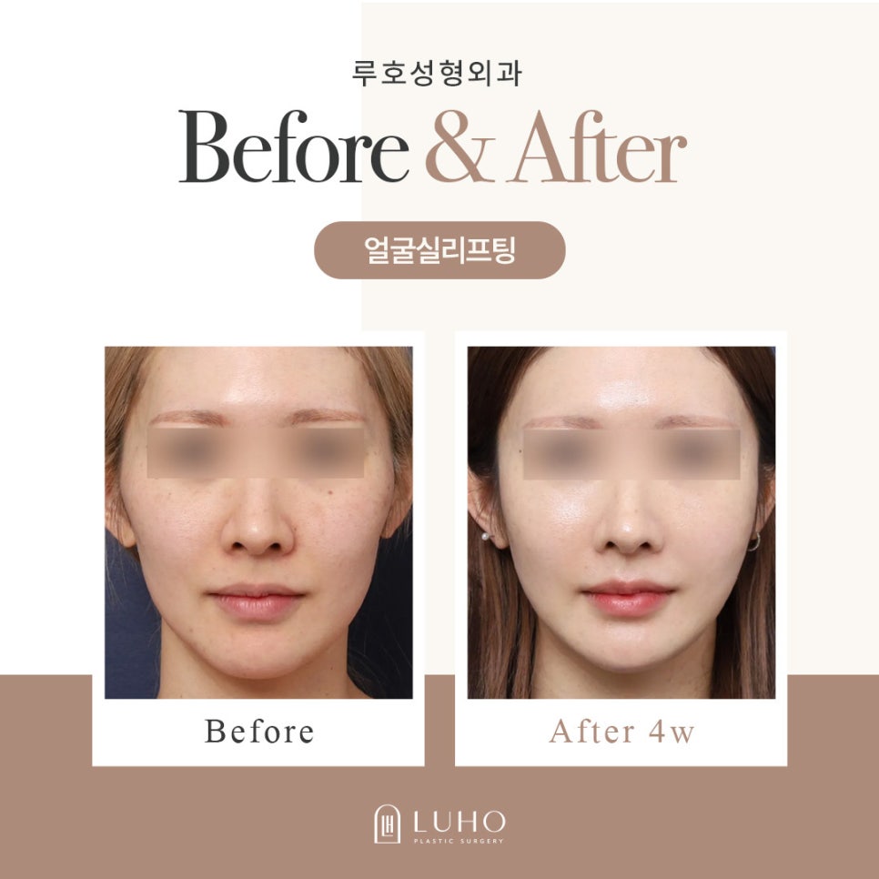 Review of Resolving Cheek Sagging with Thread Lifting Near Sinsa Station image 1