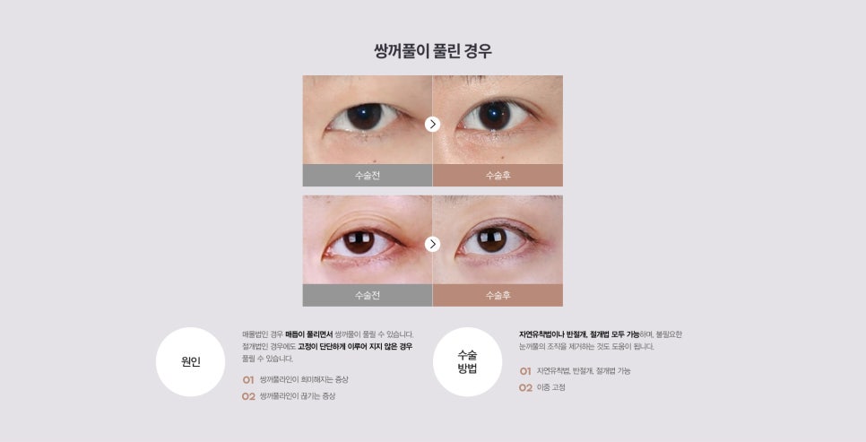 눈 수술법의 종류와 회복기간 #2 관련 이미지 10