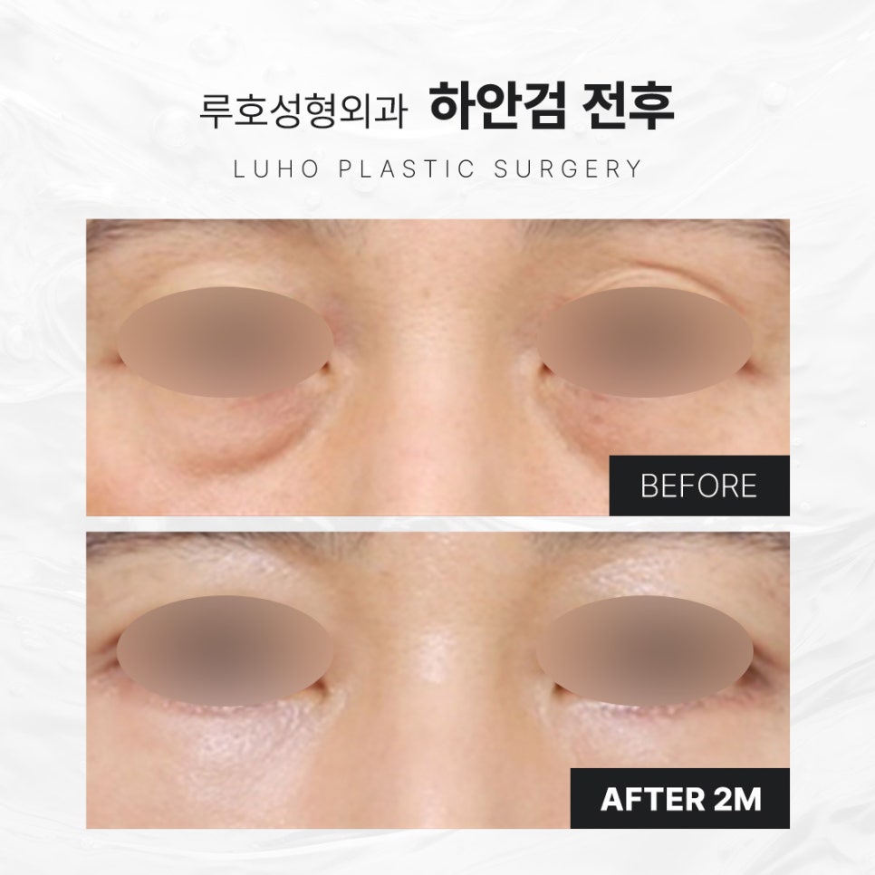 Sinsa Station Lower Blepharoplasty That Changed Heavy-Looking Under-Eyes image 1