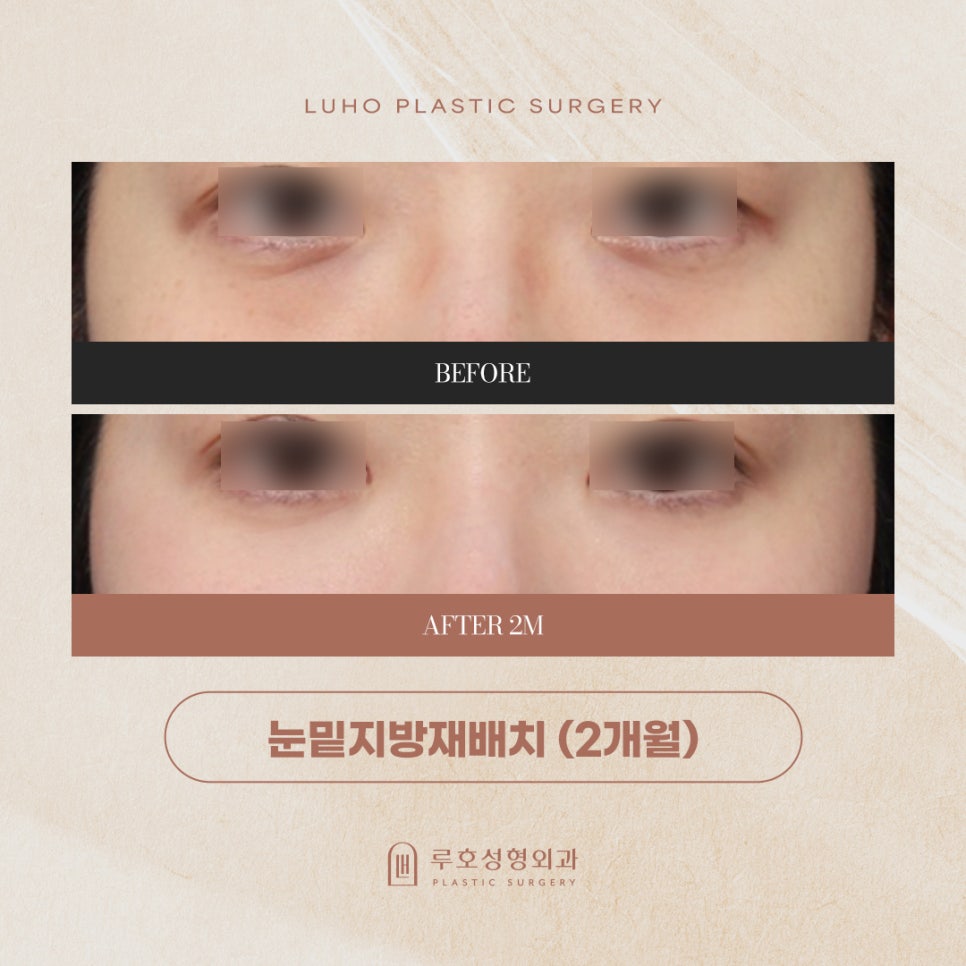 신사역 눈밑지 후기로 눈 밑 인상 변화 포인트 살펴보기 관련 이미지 1