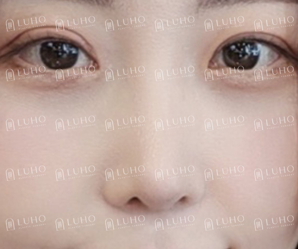 A Review of Eye & Nose Revision Surgery That Addressed the Shortcomings of Previous Surgery image 8
