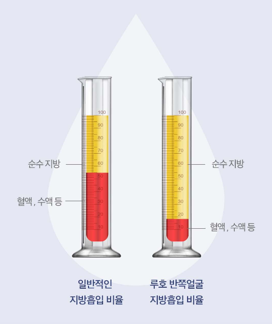 [Luho Plastic Surgery] High-Volume Half-Face Liposuction image 9