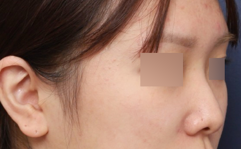 밋밋한 인상을 자려한 코로 바꿔놓은 신사역 낮은코수술 사례 관련 이미지 2