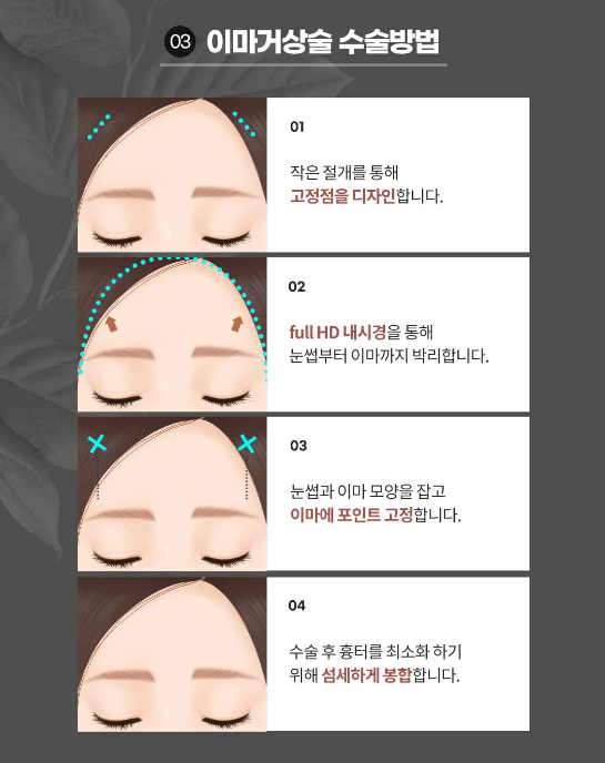 ［루호성형외과］꽃보다중년 동안성형🌹 관련 이미지 6