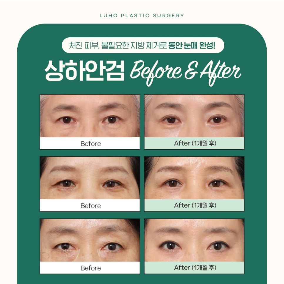 루호성형외과 눈가부터 젊어지는 중년 눈성형 관련 이미지 2