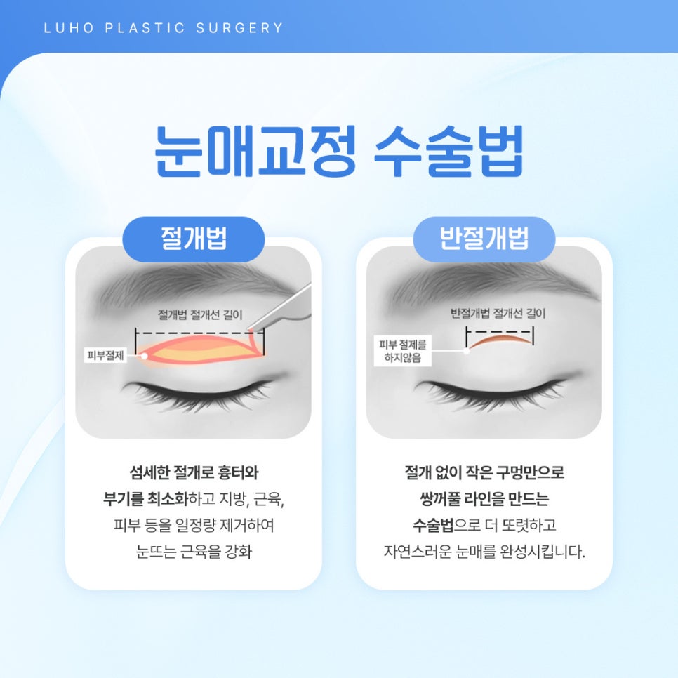 신사역 눈매교정 재수술, 안검하수 개선한 후기 관련 이미지 4