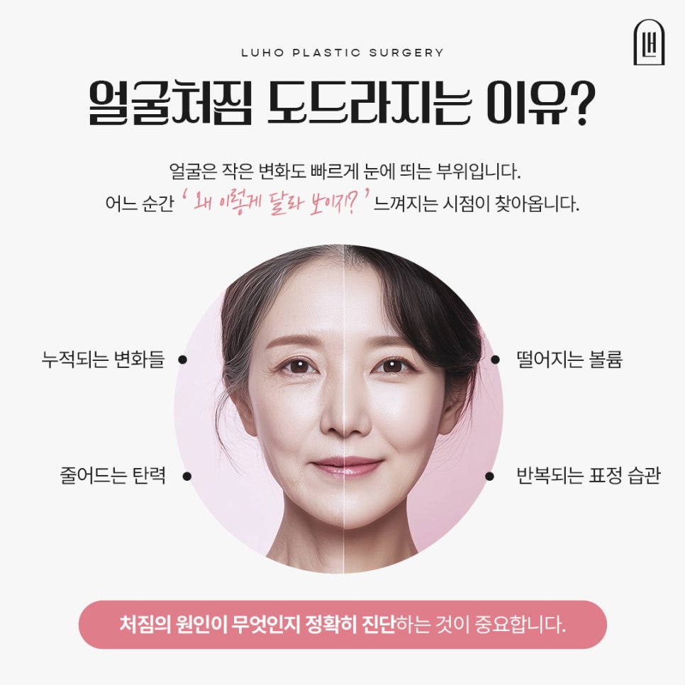 A Case of Facelift Surgery at Sinsa Station That Restored Weakened Midface Support image 2