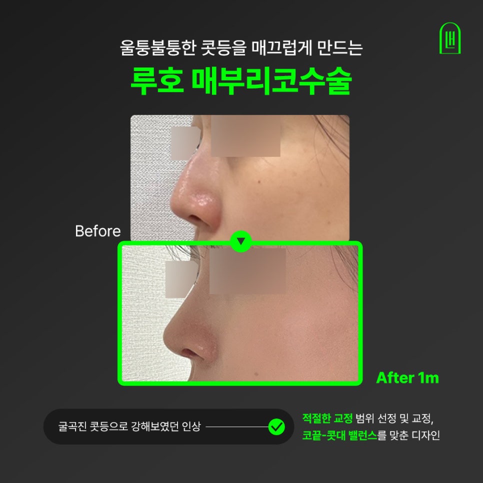 From the Curve of the Nasal Bridge to the Tip: Refining the Line with Hump Nose Surgery image 1