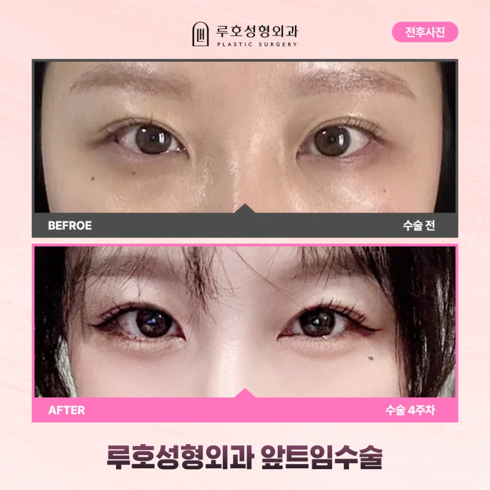 신사역 앞트임수술 경과별 비교하기 관련 이미지 1