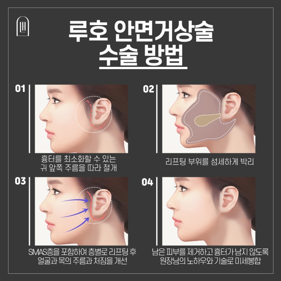 Facelift Surgery image 4