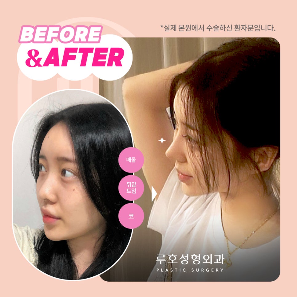 ［루호성형외과］수술 전/후 사진 비교하기 관련 이미지 2