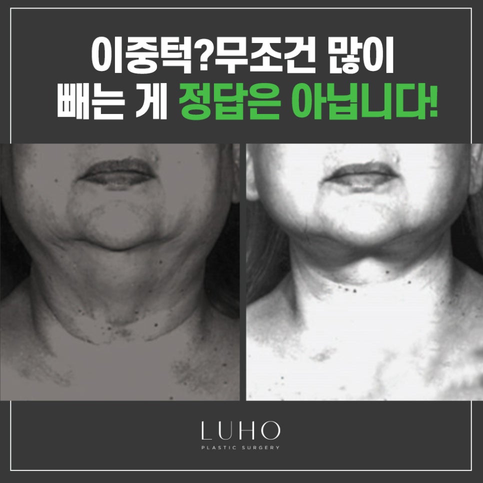 루호성형외과의 쏙 오프 지방흡입! 관련 이미지 4