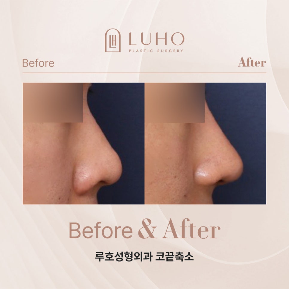 A Shinsegae Station Nose Surgery Review That Sharpened the Center of the Face with Tip Reduction image 6