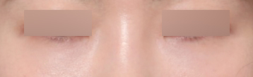 Dark Under-Eye Areas: A Review of Changes with Under-Eye Fat Repositioning at Sinsa Station image 5
