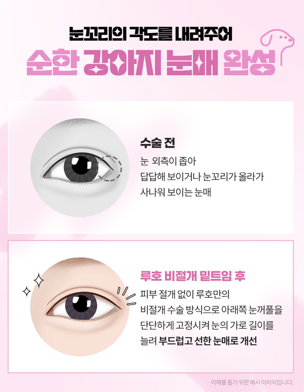 ［루호성형외과］부드럽고 청순한 눈매 관련 이미지 2