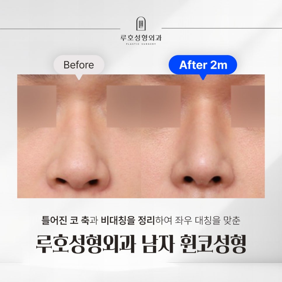 Before and After: Results That Changed with a Type-Specific Approach to Male Rhinoplasty at Sinsa Station image 1