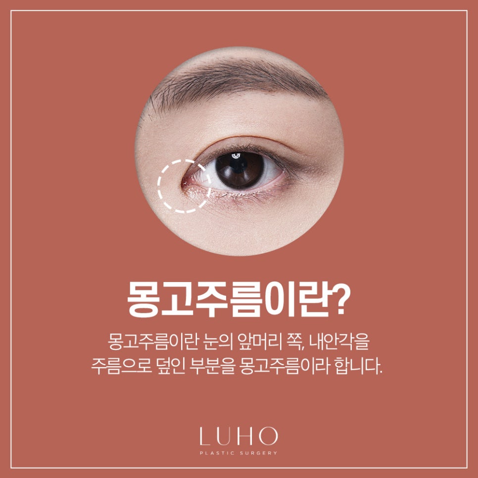 Inner Corner Epicanthoplasty for a Brighter Eye Shape image 2