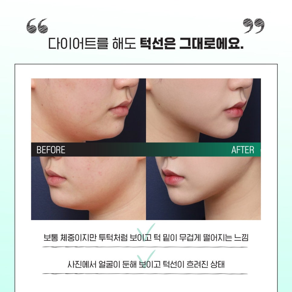 How Chin Contouring Changed with Double Chin Fat Removal image 2