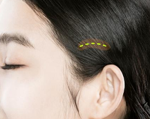 The Advantages of Lifting at a Glance: Ruho Plastic Surgery Mini Lifting image 7