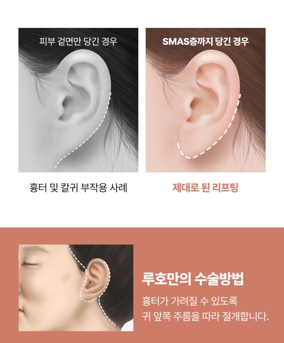 안면거상 전 알아야 할 3가지, 효과부터 흉터까지 관련 이미지 4