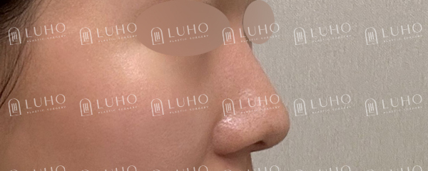 낮은 콧대와 둥근 코끝, 자연스럽게 정리한 코수술 전후 관련 이미지 2